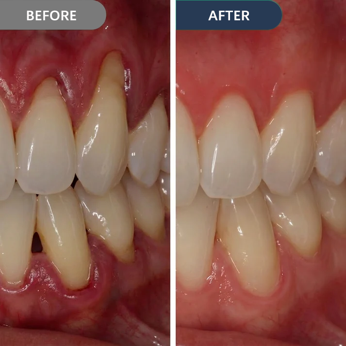 Cougex™ Precision Gum Care Gel – Daily Support for Sensitive, Tender & Bleeding Gums